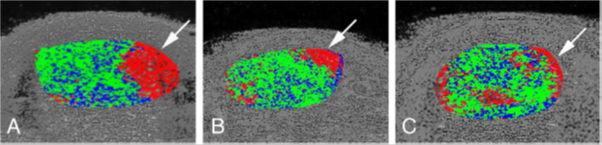 A, B: Focal disorganized echopixels in the medial part (arrows) of the midportion of the Achilles tendon C: General disorganized echopixels in medial and lateral parts of the midportion of the Achilles tendon Image from Masci et. al