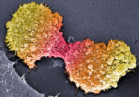 Pancreatic cancer cells
