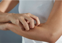 Psoriasis