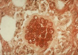 PAS stain of a coccidioidomycosis spherule