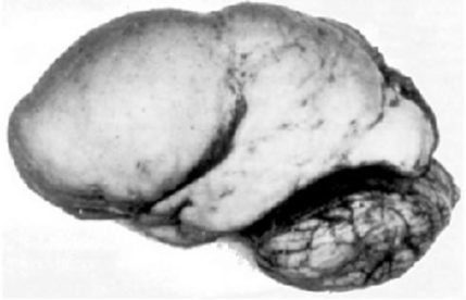 Lissencephaly