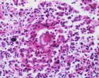 The beginnings of schistosomiasis in the body. (Image courtesy of Yale Rosen.)