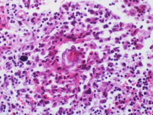 The beginnings of schistosomiasis in the body. (Image courtesy of Yale Rosen.)