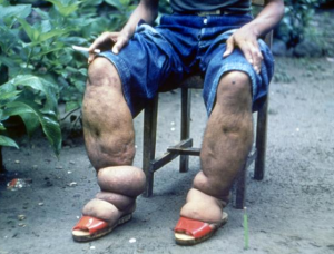 elephantiasis - image credit CDC