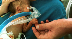 800px-Premature_infant_CPAP-620x342