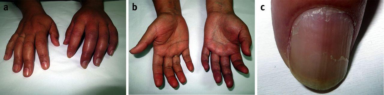 CRPS image full
