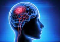 brain cancer